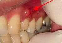 フィステルの画像