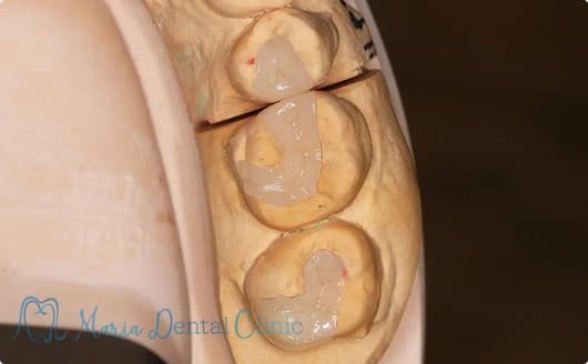 フィッティング：補綴物と歯の適合