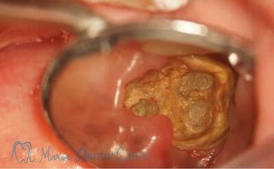 すごく大きな虫歯