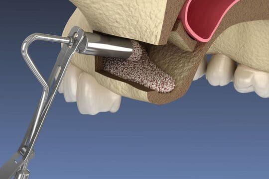 サイナスリフト