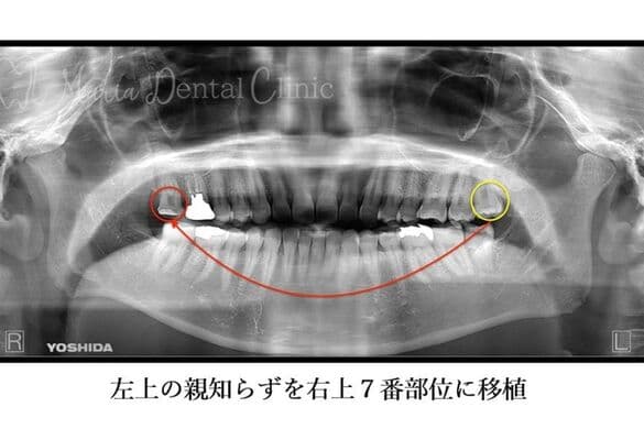 左上の親知らずを右上7番部位に移植