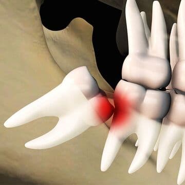 親知らずが引き起こすトラブルの写真