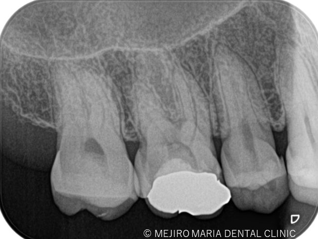 症例 精密根管治療による抜髄処置 初回根管治療 目白マリア歯科 目白 下落合の歯医者