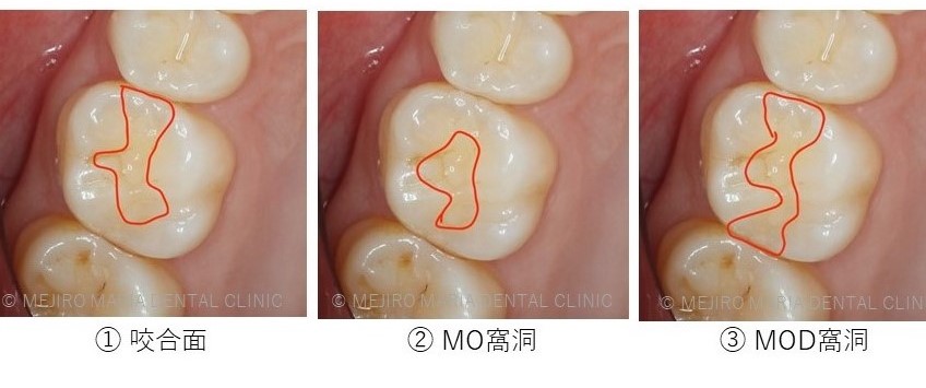 虫歯処置後の補綴物 詰め物 の考え方 材料ごとの利点欠点 レジン 院長宮澤 目白マリア歯科 目白 下落合の歯医者