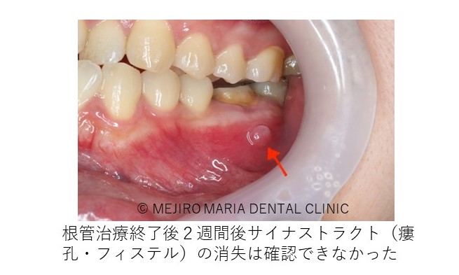 症例 歯根端切除術により抜歯を覚悟していた歯の保存に成功 目白マリア歯科 目白 下落合の歯医者