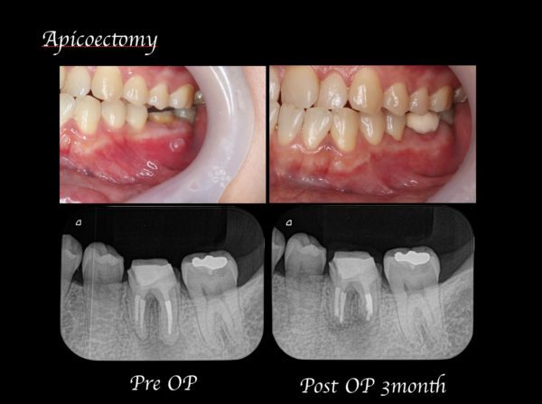 症例 歯根端切除術により抜歯を覚悟していた歯の保存に成功 目白マリア歯科 目白 下落合の歯医者