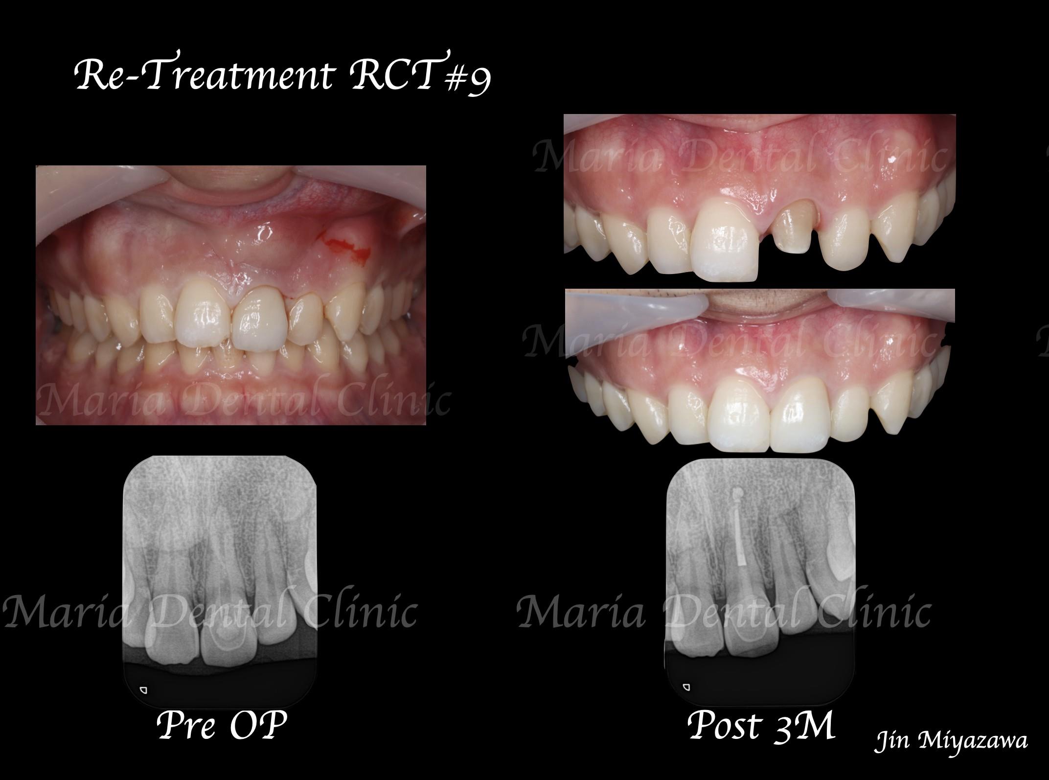 症例 前歯のセラミック修復による審美的回復 前歯部1歯補綴 外科的精密根管治療 目白マリア歯科 目白 下落合の歯医者