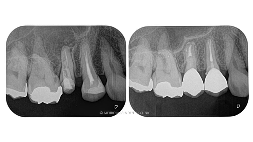 【症例】精密根管治療の費用対効果をどう考えるか（再根管治療）