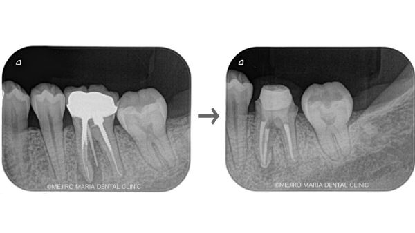 症例】根管治療のトラブルケース:「破折ファイル」の対処法と考え方 | 目白・下落合の歯医者｜目白マリア歯科