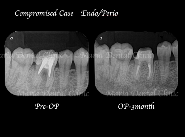 目白マリア歯科｜歯周形成外科の症例｜【症例】難症例・根の病気と歯周病が併発した症例２（世界基準の精密根管治療と最先端の歯周組織再生療法を用いて全ての問題を解決）｜治療前後比較レントゲン画像