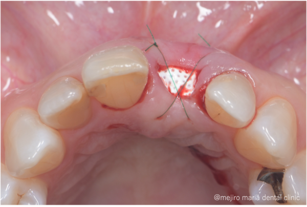 目白マリア歯科｜歯周形成外科の症例｜【症例】抜歯後の歯茎の凹みを低侵襲で予防し、接着性ブリッジを用いてインプラントを回避 歯槽堤保存術（Alveolar Ridge Preservation ; ARP） ｜切開を加えシートで被せた
