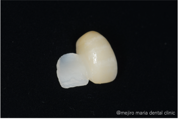 目白マリア歯科｜歯周形成外科の症例｜【症例】抜歯後の歯茎の凹みを低侵襲で予防し、接着性ブリッジを用いてインプラントを回避 歯槽堤保存術（Alveolar Ridge Preservation ; ARP） ｜ブリッジ