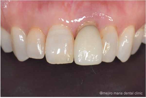 目白マリア歯科｜歯周形成外科の症例｜【症例】抜歯後の歯茎の凹みを低侵襲で予防し、接着性ブリッジを用いてインプラントを回避 歯槽堤保存術（Alveolar Ridge Preservation ; ARP） ｜治療前