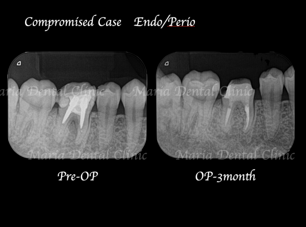 目白マリア歯科|歯周形成外科の症例|【症例】難症例・根の病気と歯周病が併発した症例2(世界基準の精密根管治療と最先端の歯周組織再生療法を用いて全ての問題を解決)|治療前後比較レントゲン画像