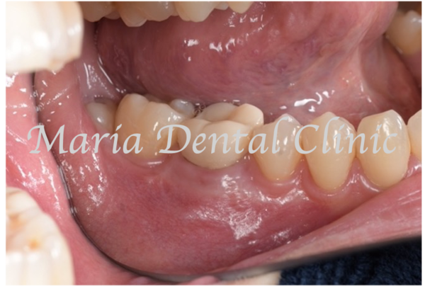 目白マリア歯科｜歯周形成外科の症例｜【症例】難症例・根の病気と歯周病が併発した症例２（世界基準の精密根管治療と最先端の歯周組織再生療法を用いて全ての問題を解決）｜治療後3ヶ月