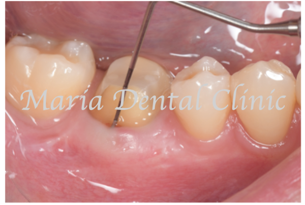 目白マリア歯科｜歯周形成外科の症例｜【症例】難症例・根の病気と歯周病が併発した症例２（世界基準の精密根管治療と最先端の歯周組織再生療法を用いて全ての問題を解決）｜比較治療後