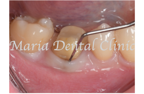 目白マリア歯科｜歯周形成外科の症例｜【症例】難症例・根の病気と歯周病が併発した症例２（世界基準の精密根管治療と最先端の歯周組織再生療法を用いて全ての問題を解決）｜術前