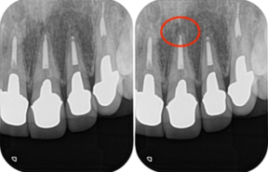 治療前レントゲン画像①|【症例】セラミック治療後に発症した根尖性歯周炎に対する歯根端切除術|目白マリア歯科