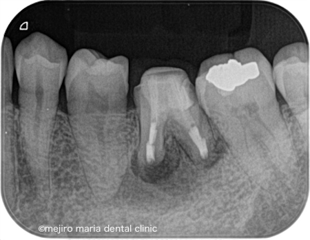 目白マリア歯科｜歯周形成外科の症例｜【症例】抜歯を宣告された歯・難治性の根尖性歯周炎を精密根管治療にて治癒に導いた症例｜術後レントゲン
