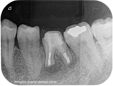 目白マリア歯科｜歯周形成外科の症例｜【症例】抜歯を宣告された歯・難治性の根尖性歯周炎を精密根管治療にて治癒に導いた症例｜術後レントゲン