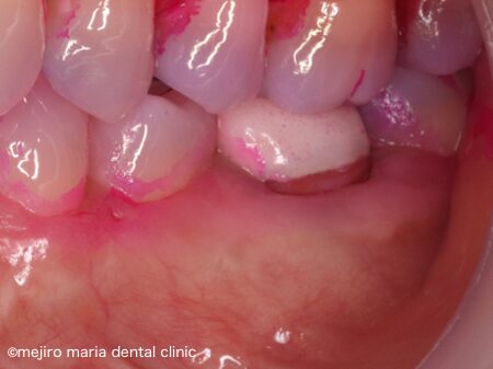 白マリア歯科｜歯周形成外科の症例｜【症例】抜歯を宣告された歯・難治性の根尖性歯周炎を精密根管治療にて治癒に導いた症例｜治療後の歯の画像