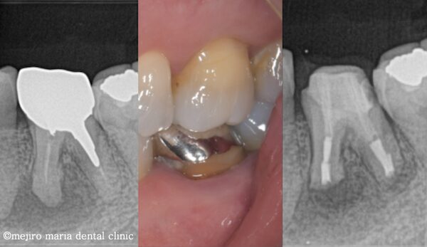 目白マリア歯科｜歯周形成外科の症例｜【症例】抜歯を宣告された歯・難治性の根尖性歯周炎を精密根管治療にて治癒に導いた症例｜術前後の比較画像