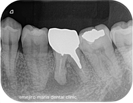 目白マリア歯科｜歯周形成外科の症例｜【症例】抜歯を宣告された歯・難治性の根尖性歯周炎を精密根管治療にて治癒に導いた症例｜術前レントゲン