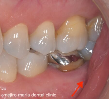目白マリア歯科｜歯周形成外科の症例｜【症例】抜歯を宣告された歯・難治性の根尖性歯周炎を精密根管治療にて治癒に導いた症例｜治療前の歯の画像