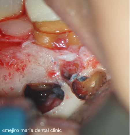 目白マリア歯科｜精密根管治療の症例｜【症例】抜歯を宣告された歯・難治性の根尖性歯周炎を精密根管治療にて治癒に導いた症例｜根尖孔外感染の画像