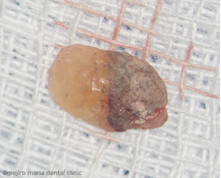 目白マリア歯科｜精密根管治療の症例｜【症例】抜歯を宣告された歯・難治性の根尖性歯周炎を精密根管治療にて治癒に導いた症例｜根尖孔外感染により歯石が付着した画像