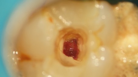 【症例】虫歯治療後の痛み、精密根管治療（抜髄）_術前のレントゲン画像、虫歯処置の箇所マーク｜目白マリア歯科