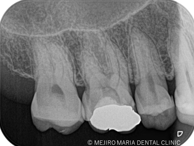 【症例】精密根管治療による抜髄処置（初回根管治療）｜歯の寿命を左右する初回根管治療