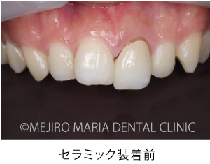 目白マリア歯科_【症例】前歯のセラミック修復による審美的な回復（前歯部１歯補綴）_セラミク装着前の口腔内写真
