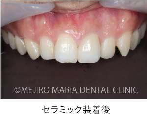目白マリア歯科_【症例】前歯のセラミック修復による審美的な回復（前歯部１歯補綴）_セラミク装着後の口腔内写真