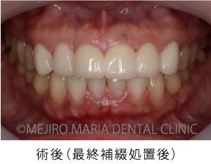 目白マリア歯科【症例】前歯の歯牙保存が不可能なケース①_治療後_術後の状態