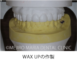 目白マリア歯科【症例】前歯の歯牙保存が不可能なケース①_治療詳細_WAX UPの作製