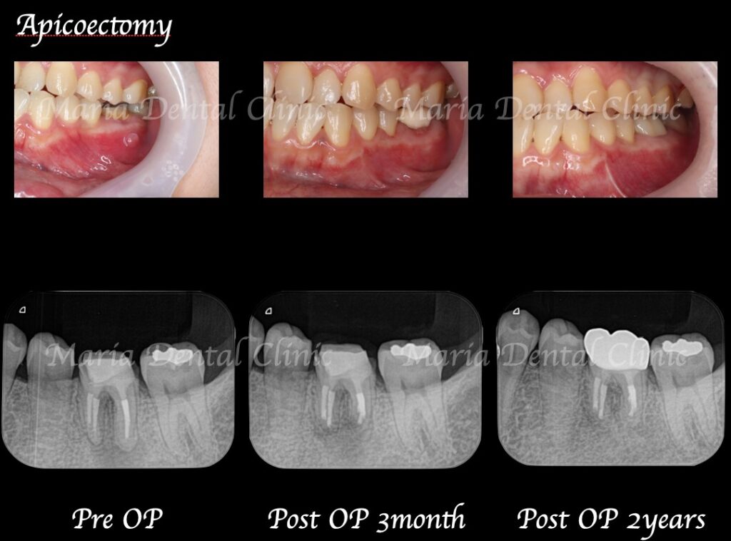 【症例】歯根端切除術により抜歯を覚悟していた歯の保存に成功