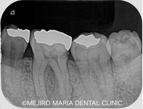 目白マリア歯科｜院長ブログ｜症例｜【症例】無症状で進行する虫歯・原因不明の歯肉の腫れを、コンセプトを守った初回根管治療（精密根管治療）で治癒｜メイン比較画像2