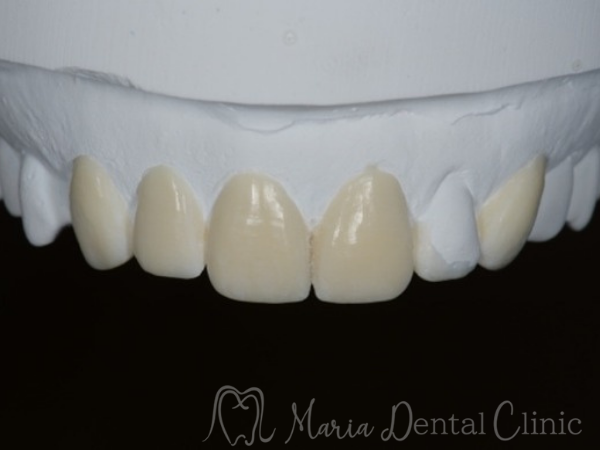 ワックスアップ｜【症例】前歯の見た目を改善し自然なスマイルラインを獲得｜目白マリア歯科