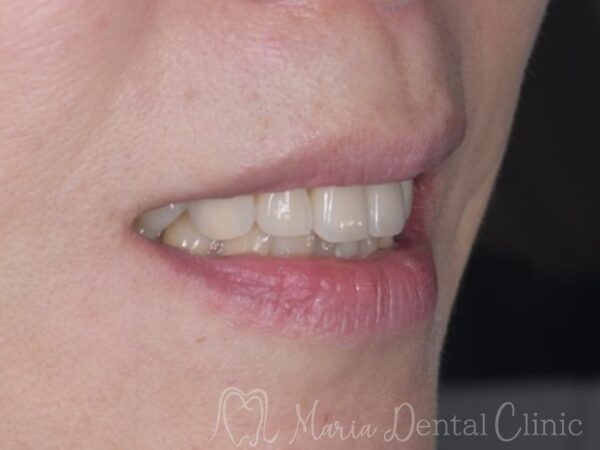 治療後の口元の写真｜【症例】前歯の見た目を改善し自然なスマイルラインを獲得｜目白マリア歯科