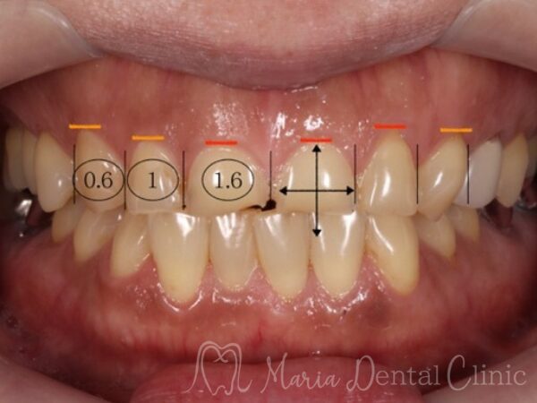 説明用写真｜【症例】前歯の見た目を改善し自然なスマイルラインを獲得｜目白マリア歯科