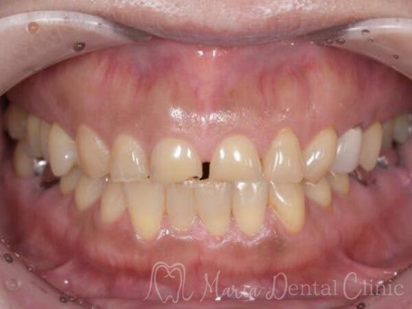 治療前の写真｜【症例】前歯の見た目を改善し自然なスマイルラインを獲得｜目白マリア歯科