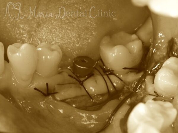 インプラント埋入時｜【症例】抜歯後に大きく失った骨をGBR（骨造成）で再建し、清掃性と長期安定性を確保したインプラント治療｜目白マリア歯科