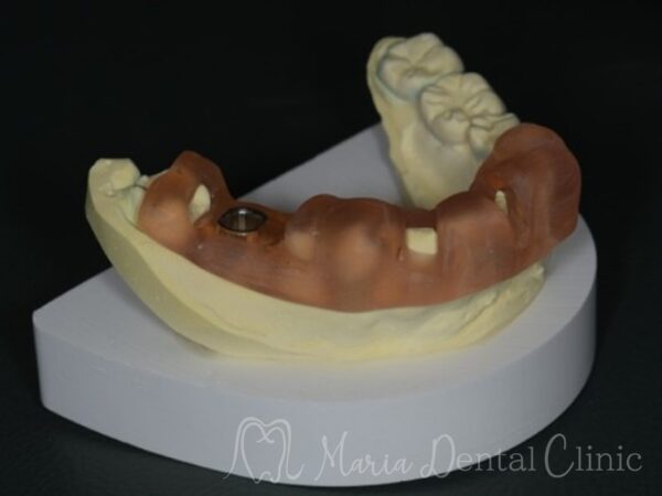 ガイデットサージェリー｜【症例】抜歯後に大きく失った骨をGBR（骨造成）で再建し、清掃性と長期安定性を確保したインプラント治療｜目白マリア歯科