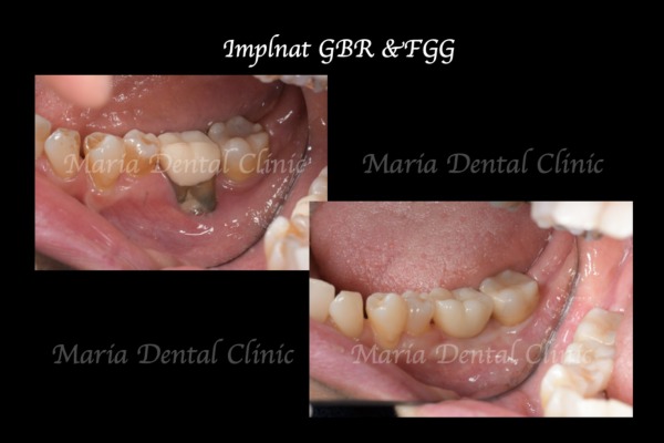 ビフォーアフター｜【症例】抜歯後に大きく失った骨をGBR（骨造成）で再建し、清掃性と長期安定性を確保したインプラント治療｜目白マリア歯科