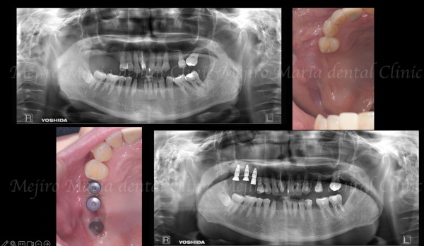 ビフォーアフター｜【症例】サイナスリフトで骨を増やし奥歯の支えを回復したインプラント治療｜目白マリア歯科