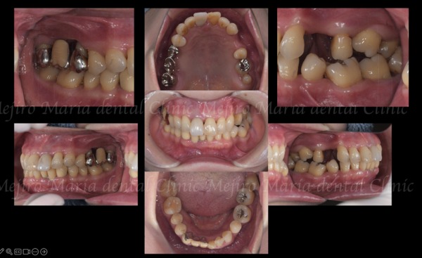 治療前の画像1｜【症例】サイナスリフトで骨を増やし奥歯の支えを回復したインプラント治療｜目白マリア歯科