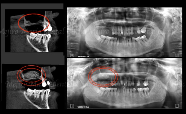 治療中の画像2｜【症例】サイナスリフトで骨を増やし奥歯の支えを回復したインプラント治療｜目白マリア歯科